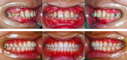 抜歯治療 vs 非抜歯治療 | 広島中央矯正歯科